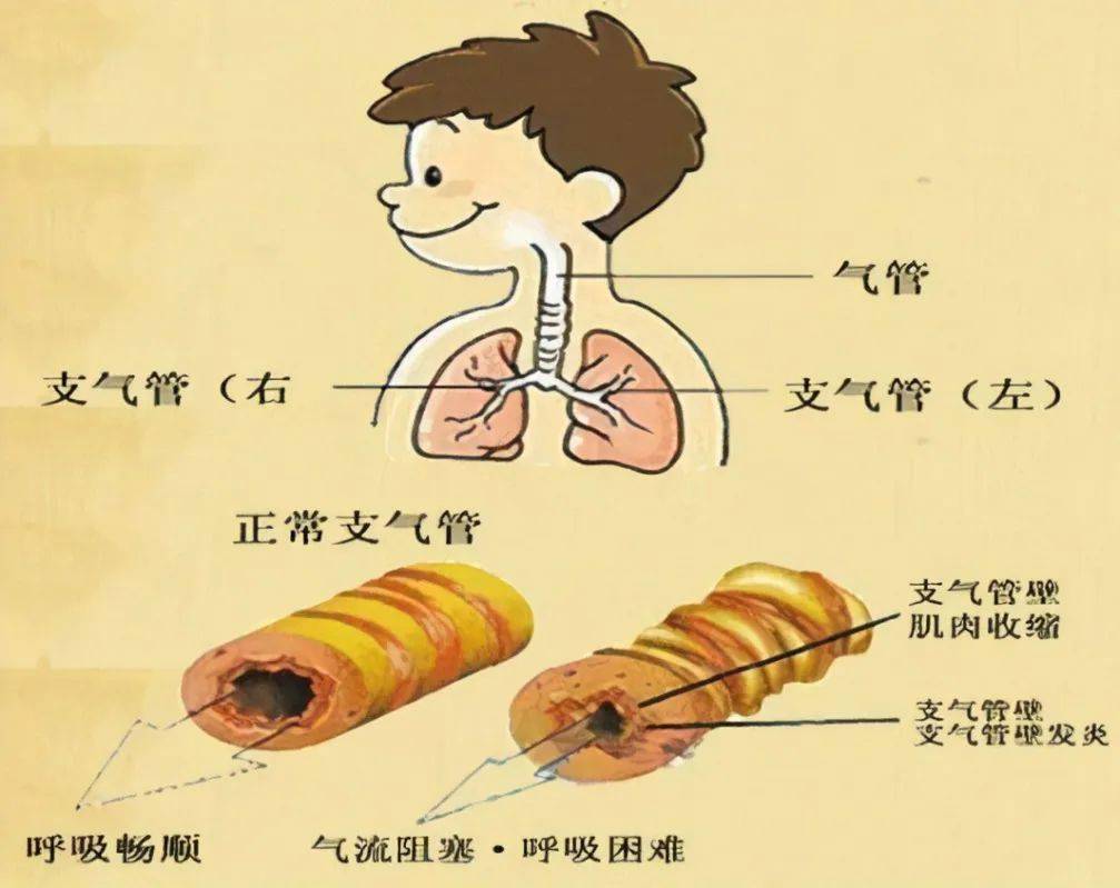 六个月支气管炎，早期识别、管理与康复之路