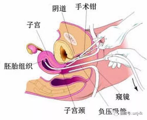 几个月做无痛流产合适，全面解析与关怀建议