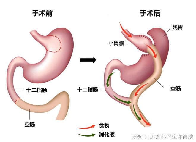 胃切除手术半个月后的饮食恢复与菜谱建议