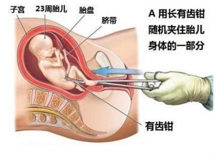 四个月堕胎胎儿图片，关于生命、伦理与法律的探讨